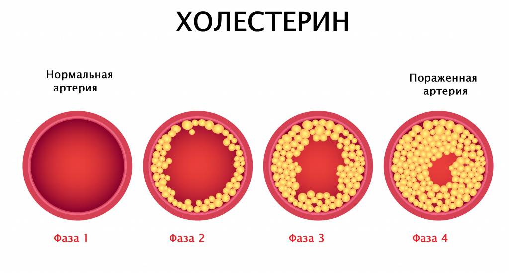 Подсказки фармацевту: лс при атеросклерозе