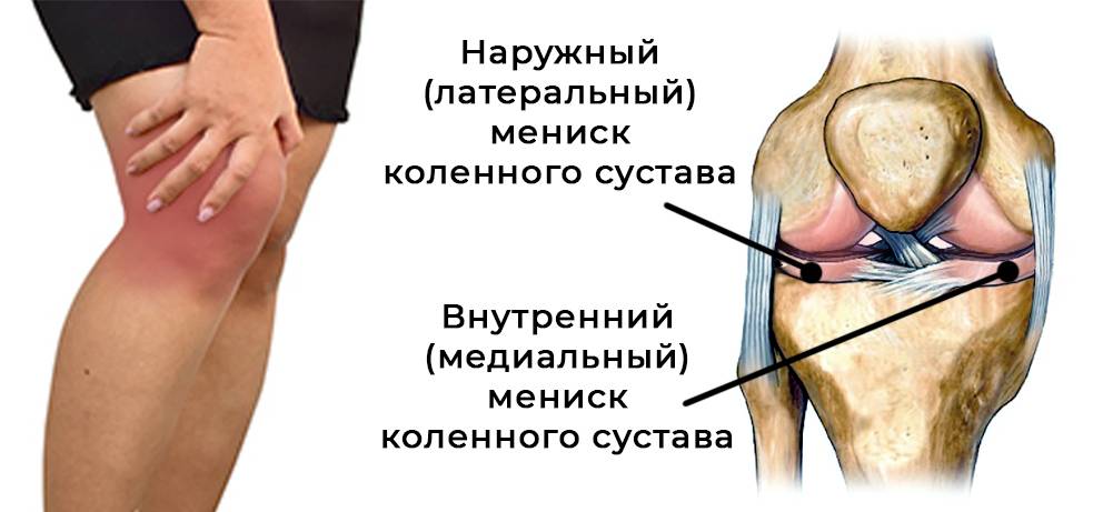 Повреждение менисков коленного сустава - симптомы болезни, профилактика и лечение повреждение менисков коленного сустава, причины заболевания и его диагностика на eurolab