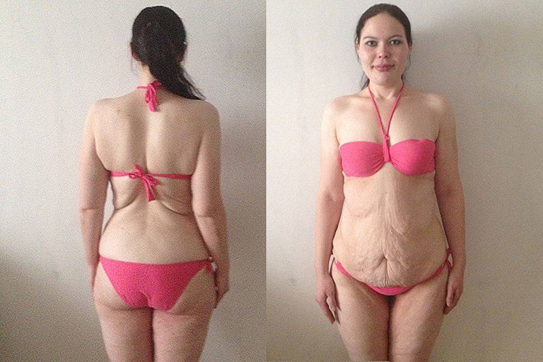 Грудь обвисла после похудения - как ее подтянуть и восстановить? | balproton.ru