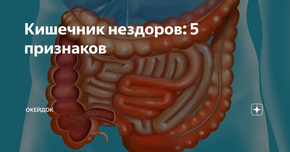 Синдром раздраженного кишечника | университетская клиника