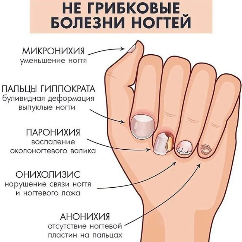 Заболевания по ногтям рук. Заболевания по виду ногтей.