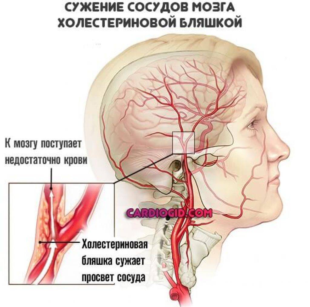 Артерии головного мозга симптомы. Ценноз церебральных артерий. Сужение сосудов головного мозга. Сужение артерий головного мозга.