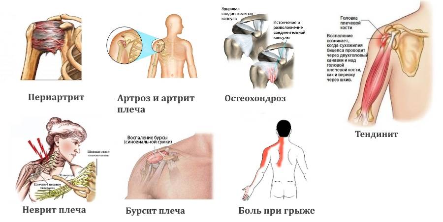 Боль в плече, причины, лечение - болезни и заболевания плечевого сустава