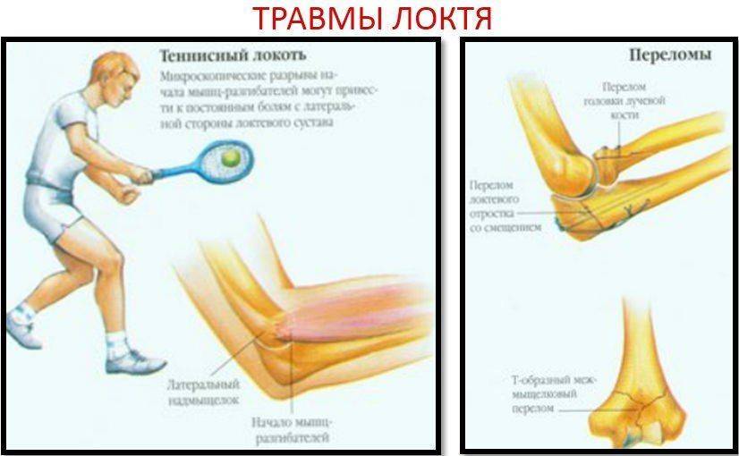 Растяжение связок локтевого сустава: причины, симптомы, лечение, в домашних условиях