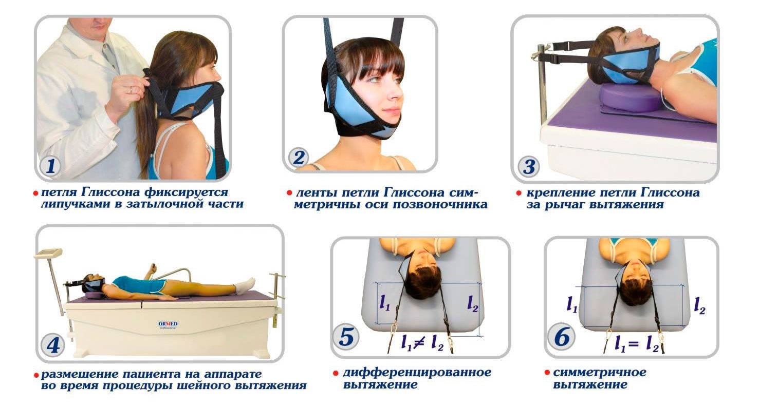Можно с помощью специальной. Аппарат тракции шейного отдела позвоночника. Вытяжение шейного отдела петлей Глиссона. Вытяжение шейного отдела позвоночника петля Глиссона. Тракционное вытяжение на шейный отдел.