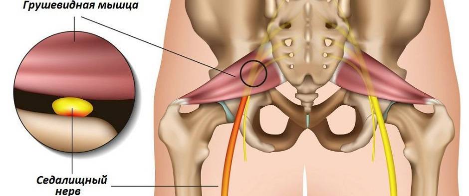 Синдром грушевидной мышцы картинки