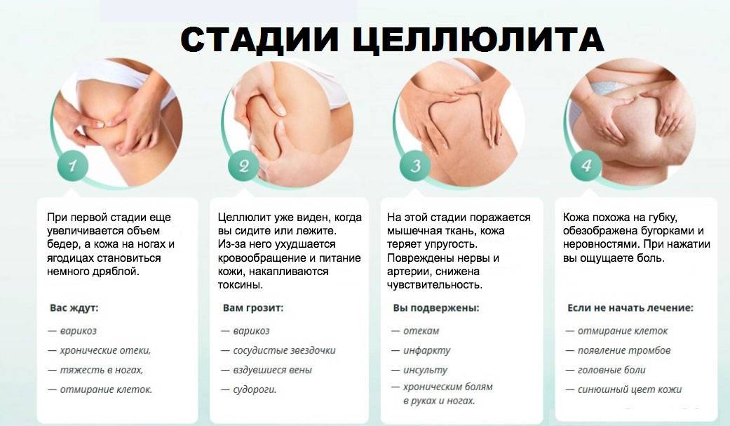 Каковы причины появление целлюлита? все тонкости и секреты!