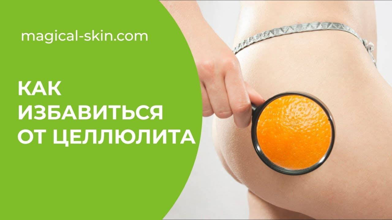 Целлюлит [что это такое]: причины, стадии, как избавиться в домашних условиях и в салоне