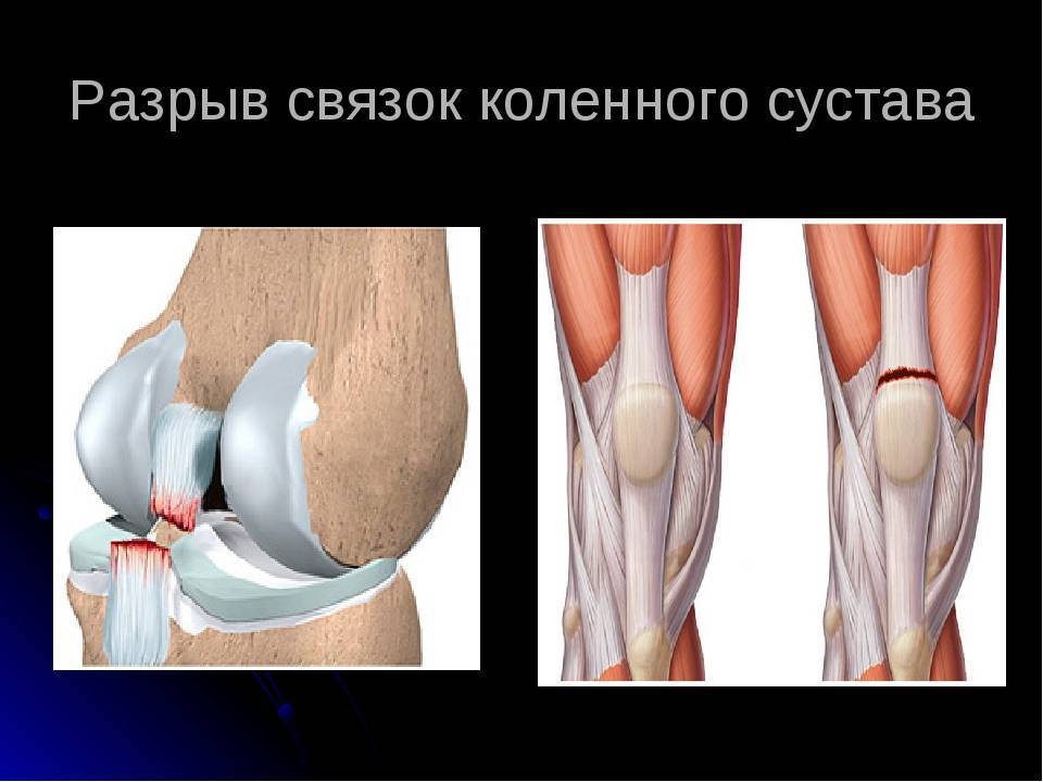 Повреждение сустава: менисков, связок | eurolab | травматология