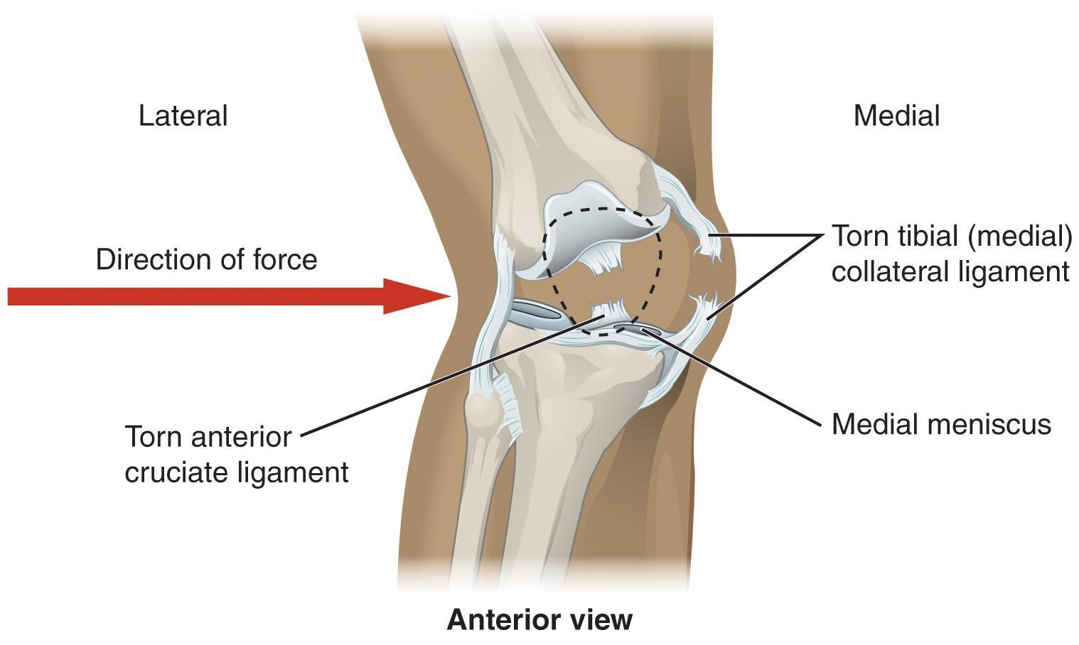Сильные боли при разгибании колена