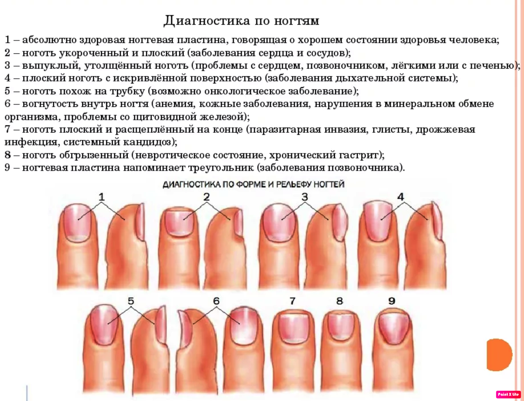 Определить заболевание по рукам. Определение болезни по состоянию ногтей. Ногти болезни организма по ногтям на руках. Выявление болезни по ногтям. Диагноз заболеваний по ногтям.