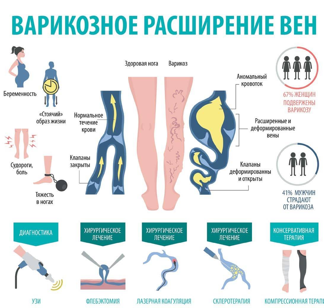 Ноги на стол: как победить варикозное расширение вен? | медицинская россия