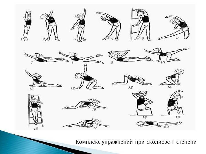 Сколиоз - симптомы и степени, диагностика и лечение. сколиоз грудного, поясничного отделов.  гимнастика, упражнения и массаж